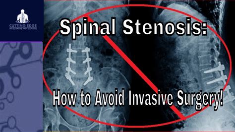 Treatment For Lower Lumbar Spinal Stenosis Minimally Invasive Lumbar