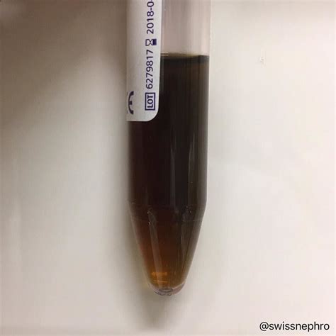 Cola Colored Urine In A Patient With Rhabdomyolysis Urinarysediment