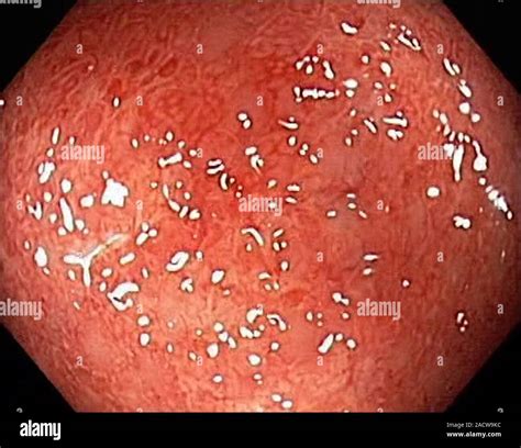Infectious Colitis Endoscope View Inflammation Of The Intestines In A