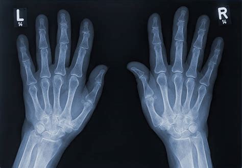 10700 Xray Of Hand Photos Stock Photos Pictures And Royalty Free