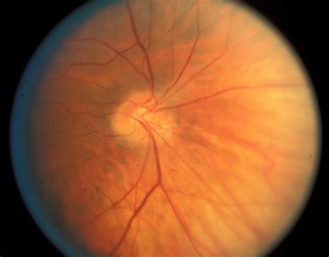 H40 Segmental Hypoplasia Retinal Tilted Dysverted Disc Eccles