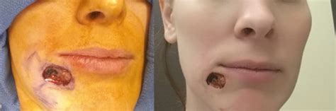 Check spelling or type a new query. Mom Mistakes Skin Cancer for Under the Skin Pimple | The ...