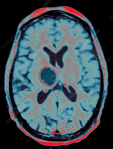 Secondary Brain Cancer Mri Scan Stock Image C0473417 Science