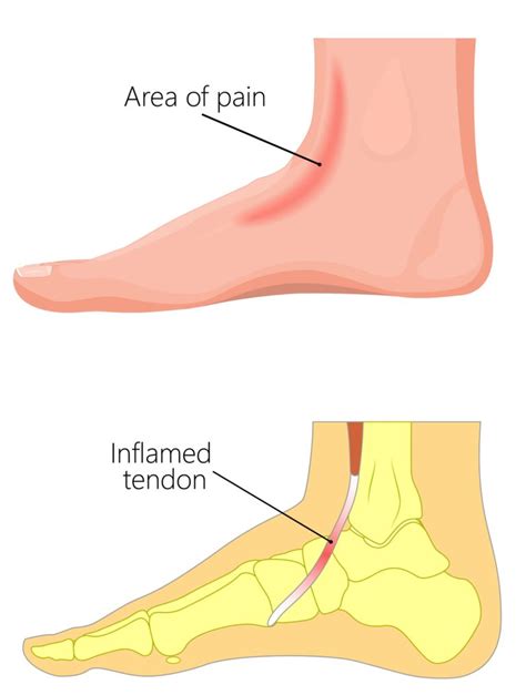 Anterior Tibialis Tendonitis Tibialis Anterior Muscle Pain Treatment