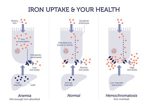 There are several types of hemochromatosis. DNA Hemochromatosis Test | DNA in the News