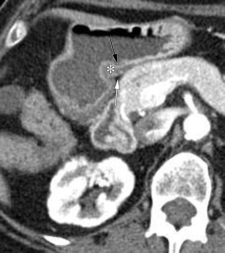 Ligaments And Lymphatic Pathways In Gastric Adenocarcinoma Radiographics