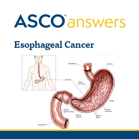 Esophageal Cancer Pack Of Fact Sheets ASCO Store