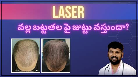 Drjohnwatts Low Level Laser Treatment For Hair Loss Best Hair
