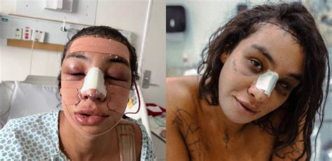 Linn Da Quebrada Entenda A Cirurgia De Feminiza O Facial Feita Pela Ex Bbb Veja Antes E Depois