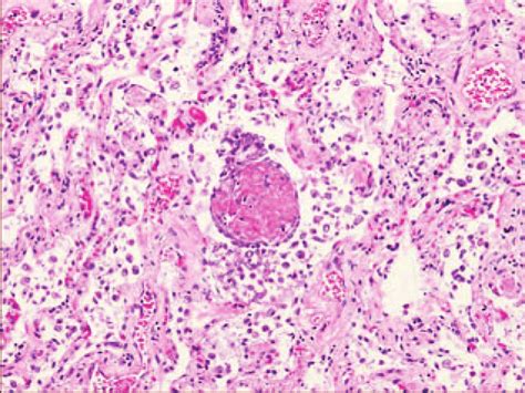 Widening Of The Alveolar Septum With Fibrotic Proliferation