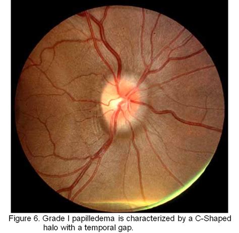 Papilledema Grades Ophthalmology The University Of Iowa