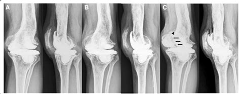 A C Postoperative Anteroposterior And Lateral Knee Radiographs Taken At