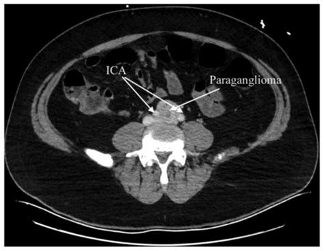 Abdominal Paraaortic Paraganglioma Management Of Intraoperative
