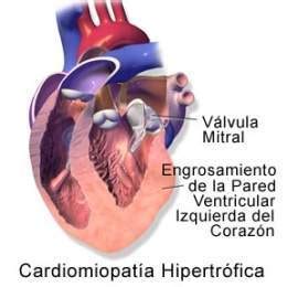 Miocardiopatía hipertrófica, pruebas complementarias, diagnóstico clínico, analítica, electrocardiograma, doppler tisular, resonancia magnética nuclear. Miocardiopatía hipertrófica - EcuRed