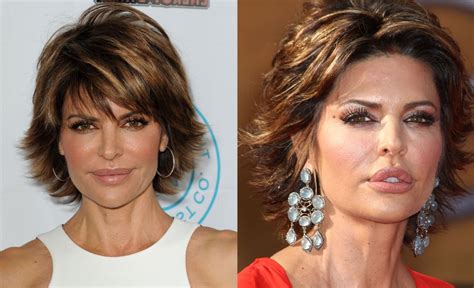 Lisa Rinna Before And After Plastic Surgery 06 Celebrity Plastic