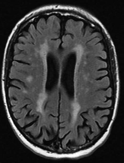 Brain Mri 8 February 12 Probable Microvascular Ischemic Changes In