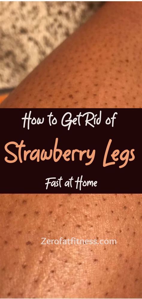 How To Get Rid Of Strawberry Legs Fast 7 Best Home Remedies