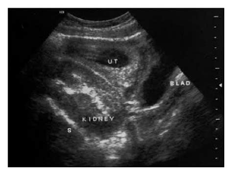 Transabdominal Sonograms In The First And Second Trimesters A Shows