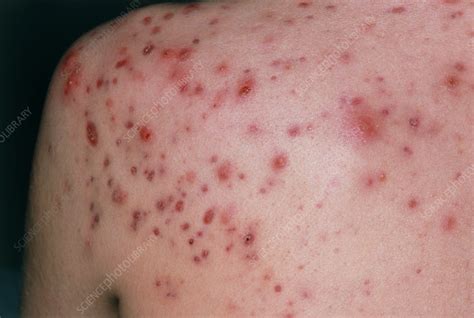 View Of Severe Acne Vulgaris On Mans Shoulder Stock Image M108