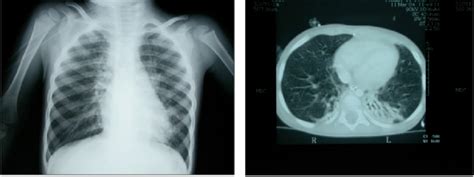 Lung Aeration And Densities In Aliards Chest X Ray Vs Ct Scan In A