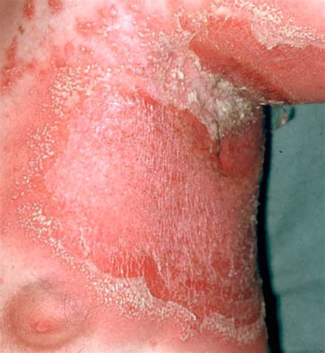 Diagnosis And Management Of Psoriasis And Psoriatic Arthritis In Adults