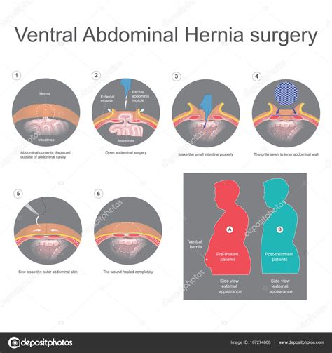 Ventral Hernia Is A Bulge Of Tissues Through An Opening Of Weakn