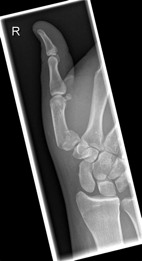 Epibasal Thumb Fracture Image