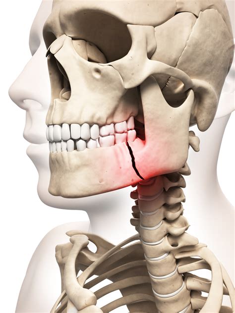 Mandibular Fractures Single Plate Fixation