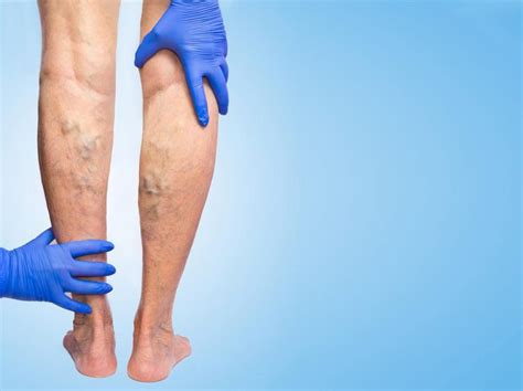 Removing Varicose Veins Has More Than Just Cosmetic Benefits Advanced