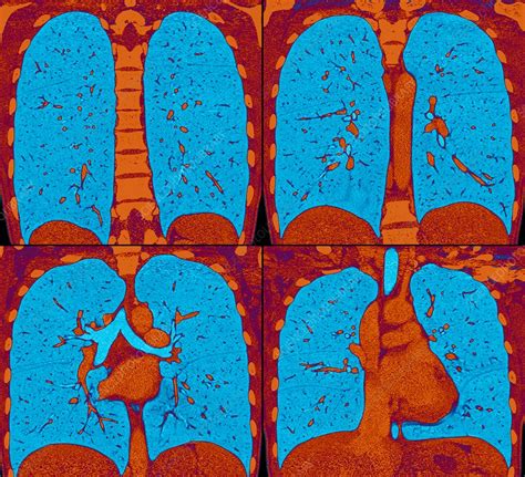 Normal Lungs And Heart Ct Scans Stock Image C0366937 Science