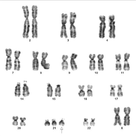 G Banded Conventional Karyotype Showing 3 Copies Of Chromosome 21 Download Scientific Diagram