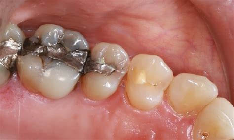 Restorative Dentist Glenroy Vic Replacement Of Silver Fillings