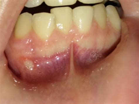 Advice With White Spot On Gums Dentistry