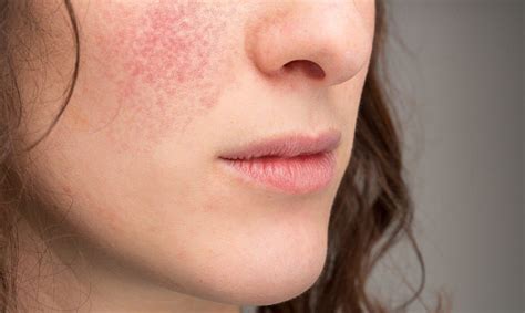 How To Treat Eczema On Face