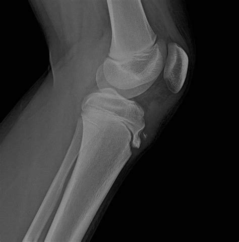 Osgood Schlatter Diseasewhat To Know