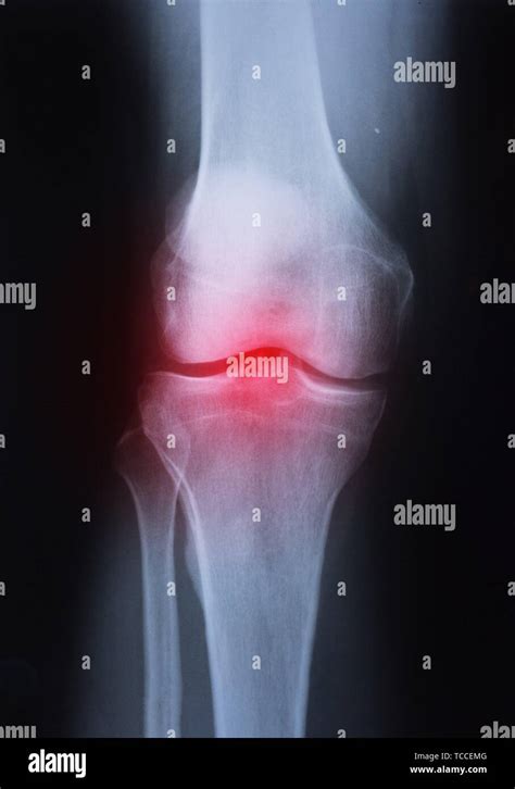 Medical X Ray Knee Joint Image With Arthritis Gout Rheumatoid Arthritis Septic Arthritis