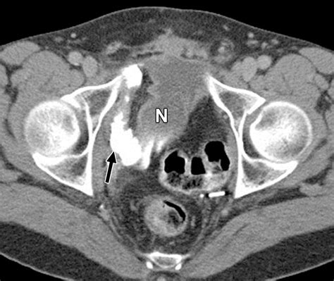 Follow The Stream Imaging Of Urinary Diversions Radiographics