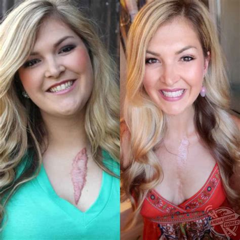 After Undergoing Heart Surgery This Woman Was Left With A Huge Scar