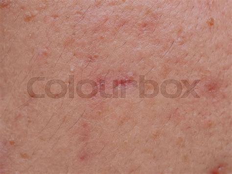 Acne On Facial Skindermatological Disease Acne Stock Image Colourbox