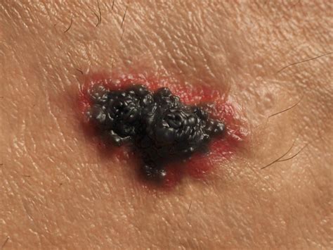 It means the melanoma has spread elsewhere in the body, away from where it. Skin Cancer Stage 4 Melanoma - CancerWalls