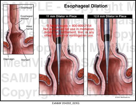 Esophageal Dilation Medical Illustration Medivisuals