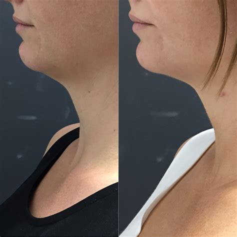 Non Surgical Neck Lift Neck Tightening For Neck Wrinkles And Lines