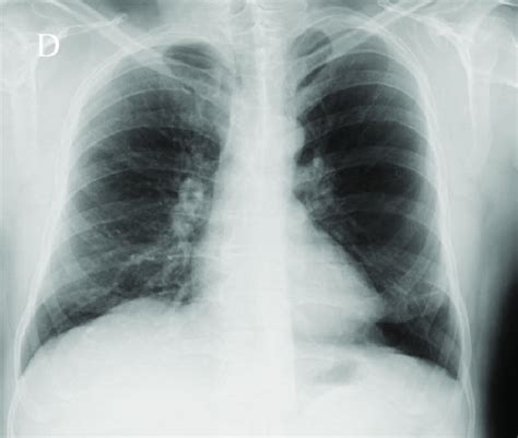 Chest Radiography Of Case 1 Showing A Hyperlucent Left Lung Download