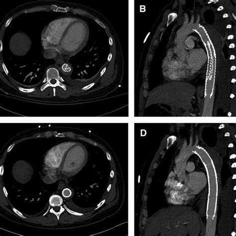 Axial And Sagittal Ct Reconstructions A And B Demonstrate Collapse Of