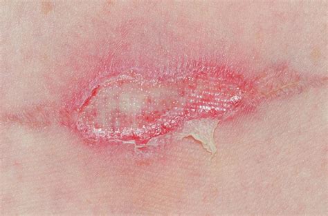 Infected Burn On The Skin Photograph By Dr P Marazziscience Photo Library