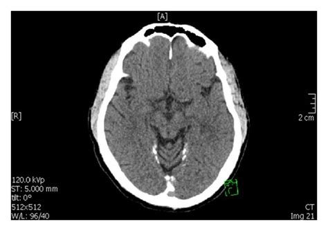 An Axial Brain Ct Scan Showing Extensive Brain Calcifications Along