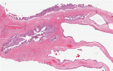 Pathology Outlines Glandular Odontogenic Cyst