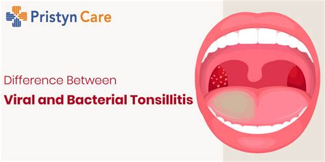 Tonsil Viral Infection