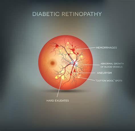 What Is Diabetic Retinopathy And What Are The Best Treatment Options