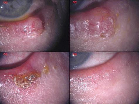 Immunotherapy With Imiquimod 5 Cream For Eyelid Nodular Basal Cell